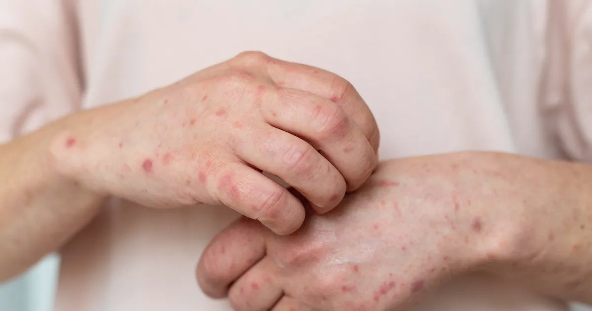 Primer caso importado en Chile desde 2023: cuáles son las características del sarampión y su forma de contagio